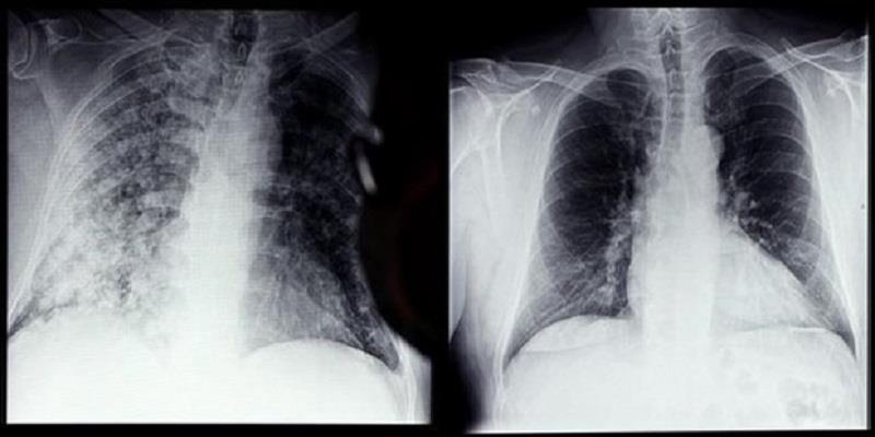 Phim chụp Xquang phổi của bệnh nhân COVID-19 (trái) và phổi của người bình thường tại bệnh viện ở Magdeburg, miền đông nước Đức, ngày 28/4/2021