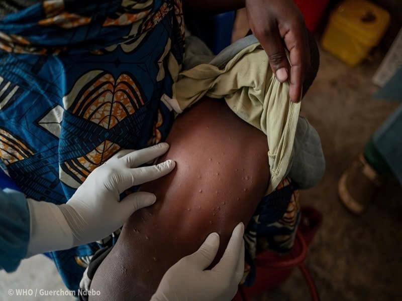 Một nhân viên y tế đang kiểm tra các tổn thương da đặc trưng của bệnh mpox trên lưng của một trẻ nhỏ tại Bệnh viện Đa khoa Nyiragongo, phía Bắc Goma, CHDC Congo, ngày 14/8/2024. (Ảnh: WHO)